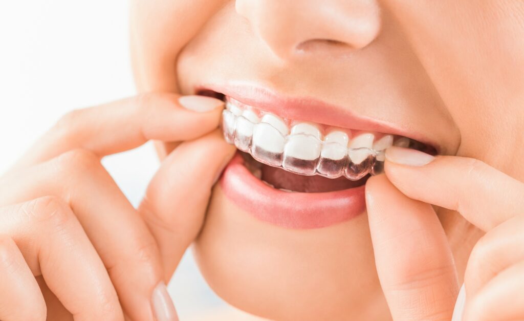 Invisalign 101: Everything You Need to Know