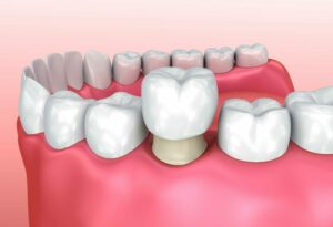 Restoring Your Smile with a Dental Crown