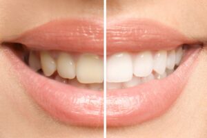 February - Teeth Whitening